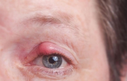 VIÊM LOÉT GIÁC MẠC DO HERPES - NGUYÊN NHÂN, TRIỆU CHỨNG VÀ ĐIỀU TRỊ